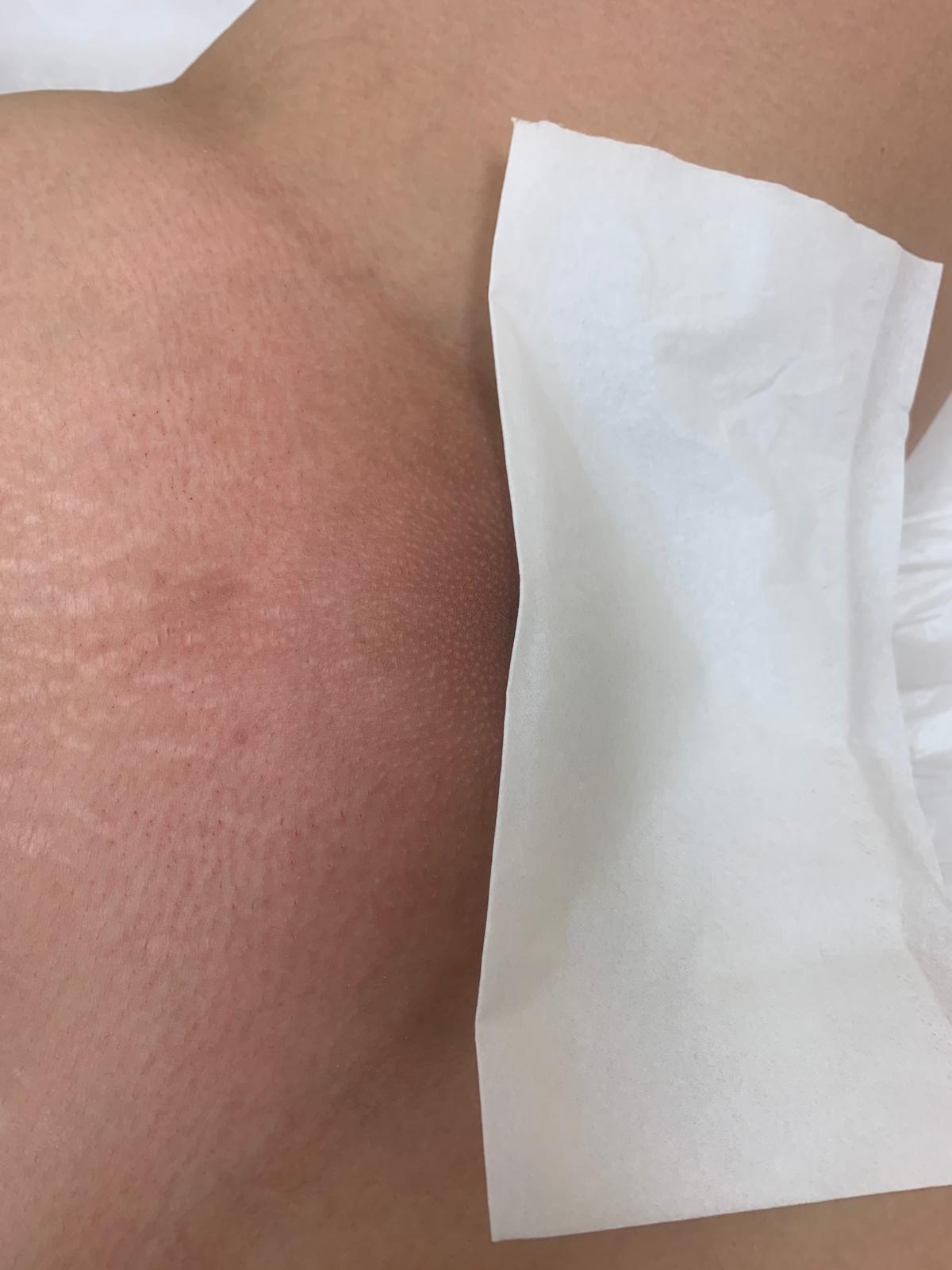 After Brazilian wax treatment, example 2
