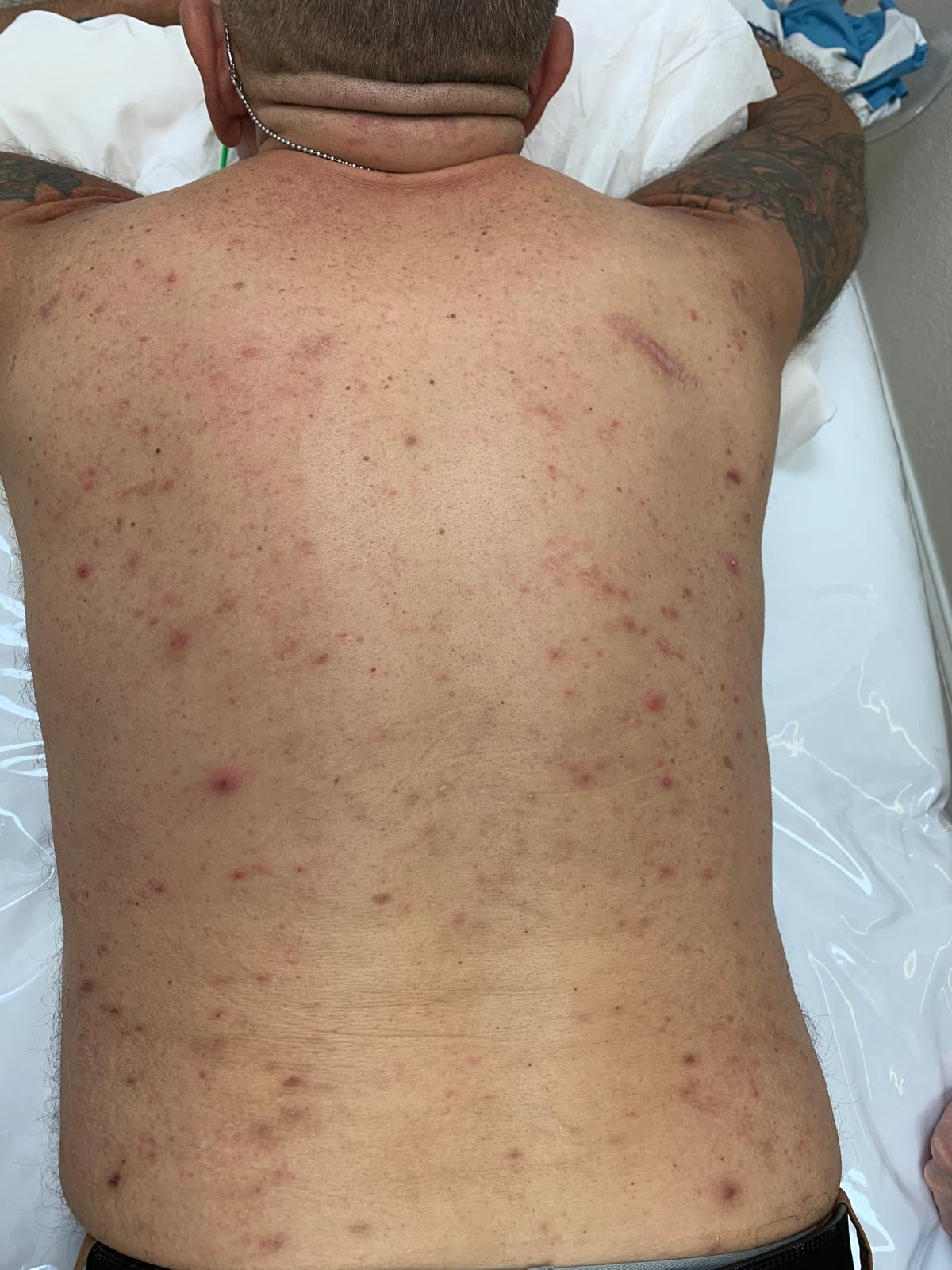 After Brazilian wax treatment, example 4