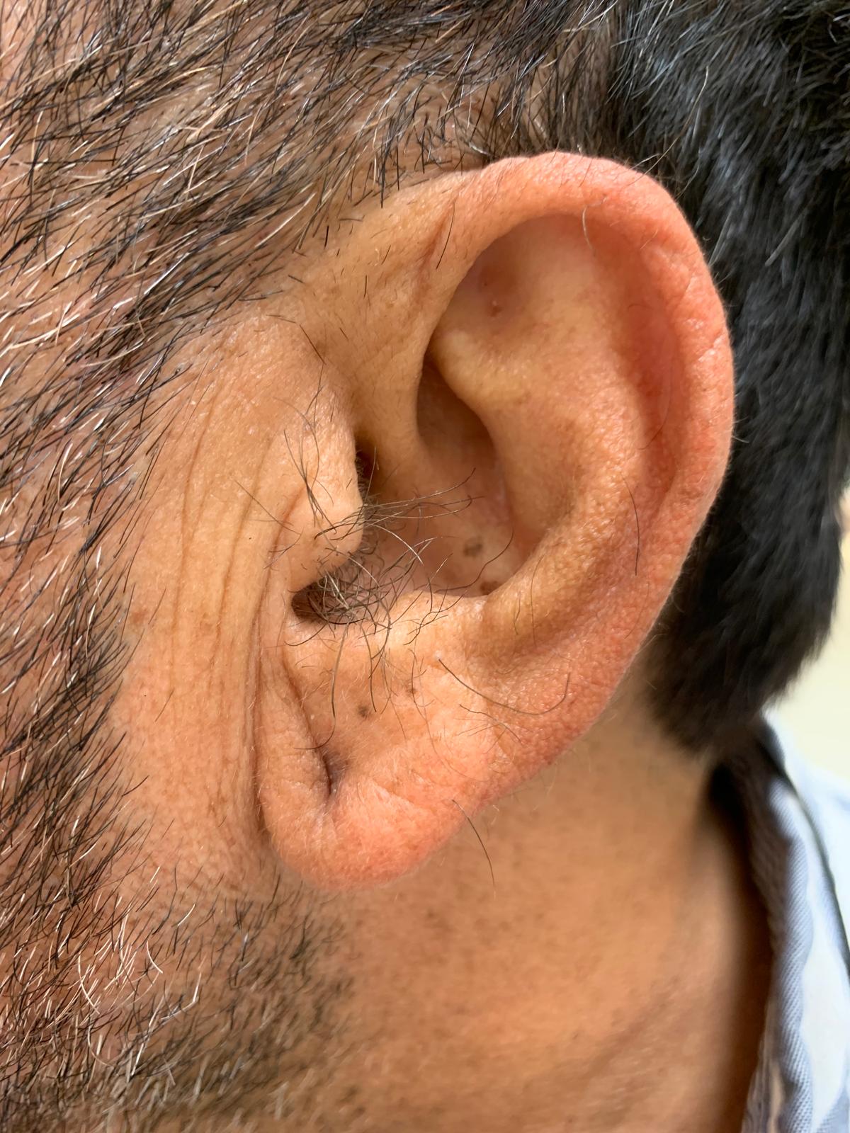 Before Brazilian wax treatment, example 1